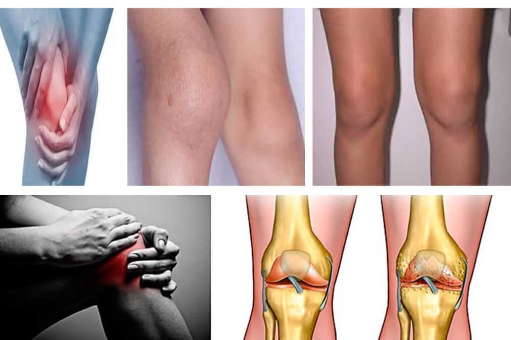Knee articulation symptoms